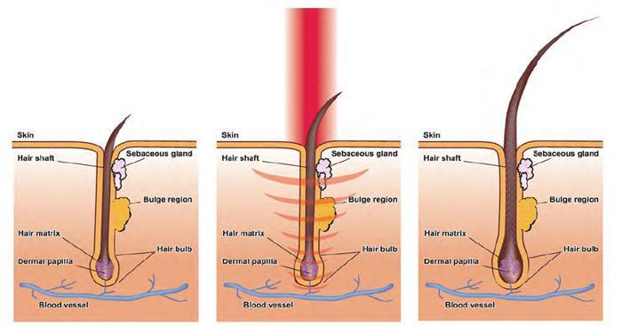 Nurbini® Home Medical Hair Growth Device