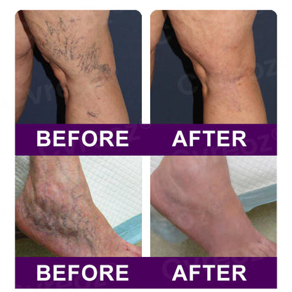 👩🏼‍⚕️Recommended by AHRQ🍀 Cvreoz® Polidocanol Nano Patches for Varicose Veins⭐️Stick It & Forget It