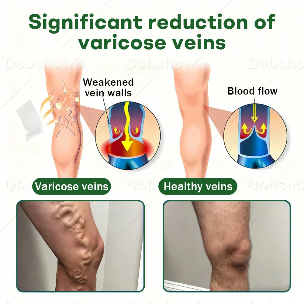 🎅 𝘾𝙝𝙧𝙞𝙨𝙩𝙢𝙖𝙨 𝙎𝙖𝙡𝙚 | Croaie® VeinLock Microneedle Patch