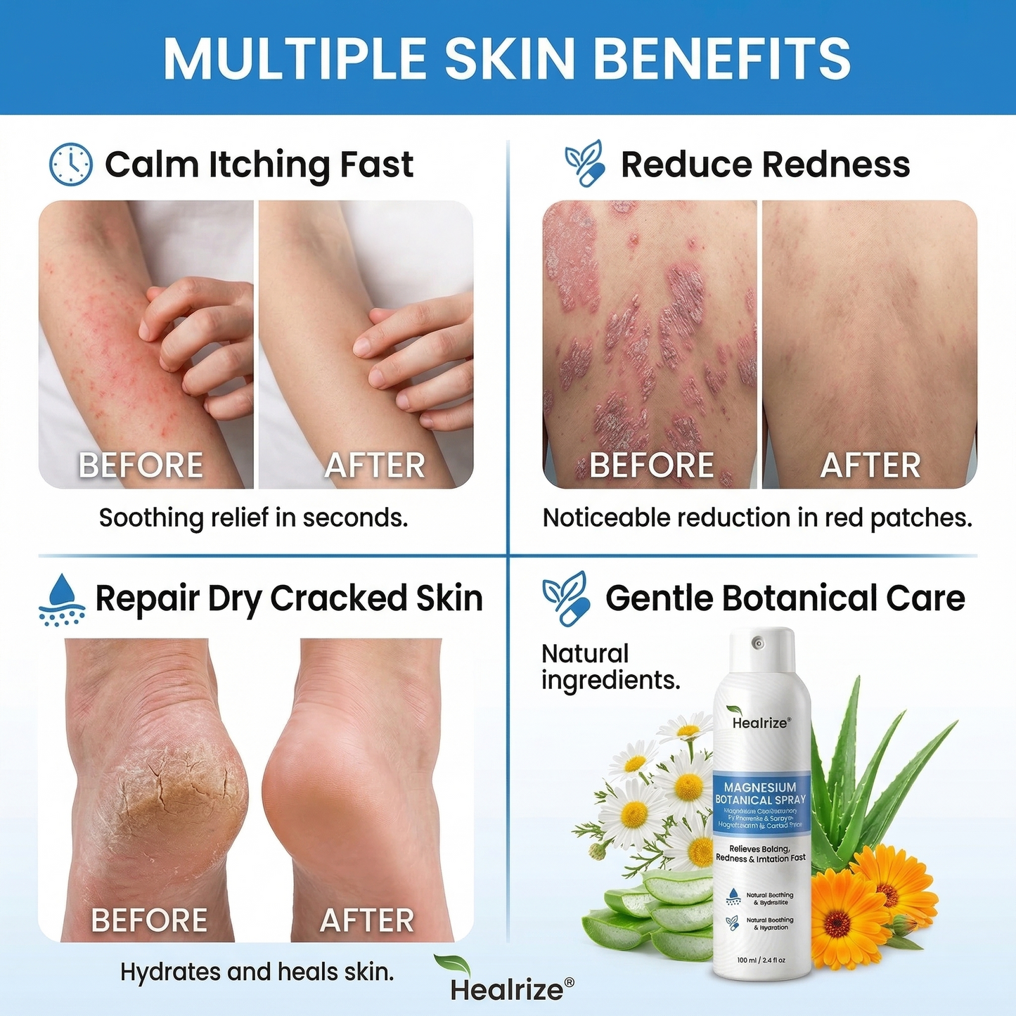🔥Healrize® Magnesium Botanical Spray – Advanced Skin Recovery for Psoriasis & Eczema | Rapid Soothing, Steroid-Free