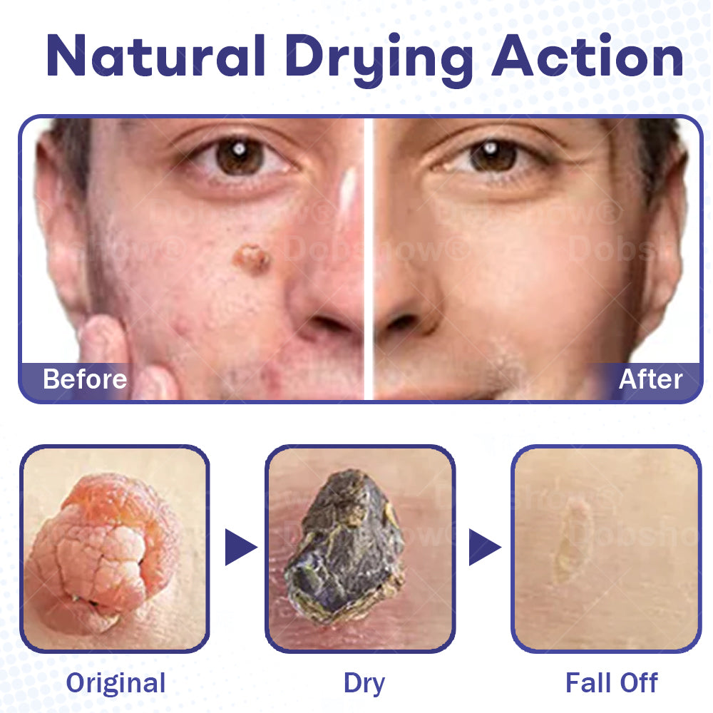 Cvreoz®  Wart Eraser Pro