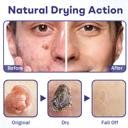 Cvreoz®  Wart Eraser Pro