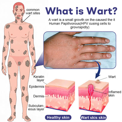 Cvreoz®  Wart Eraser Pro