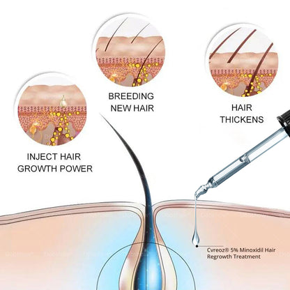 ⓒⓥⓡⓔⓞⓩ® 5% Minoxidil Hair Pro-growth Treatment