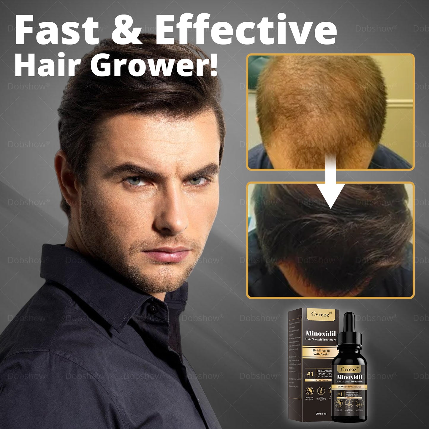 ⓒⓥⓡⓔⓞⓩ® 5% Minoxidil Hair Pro-growth Treatment