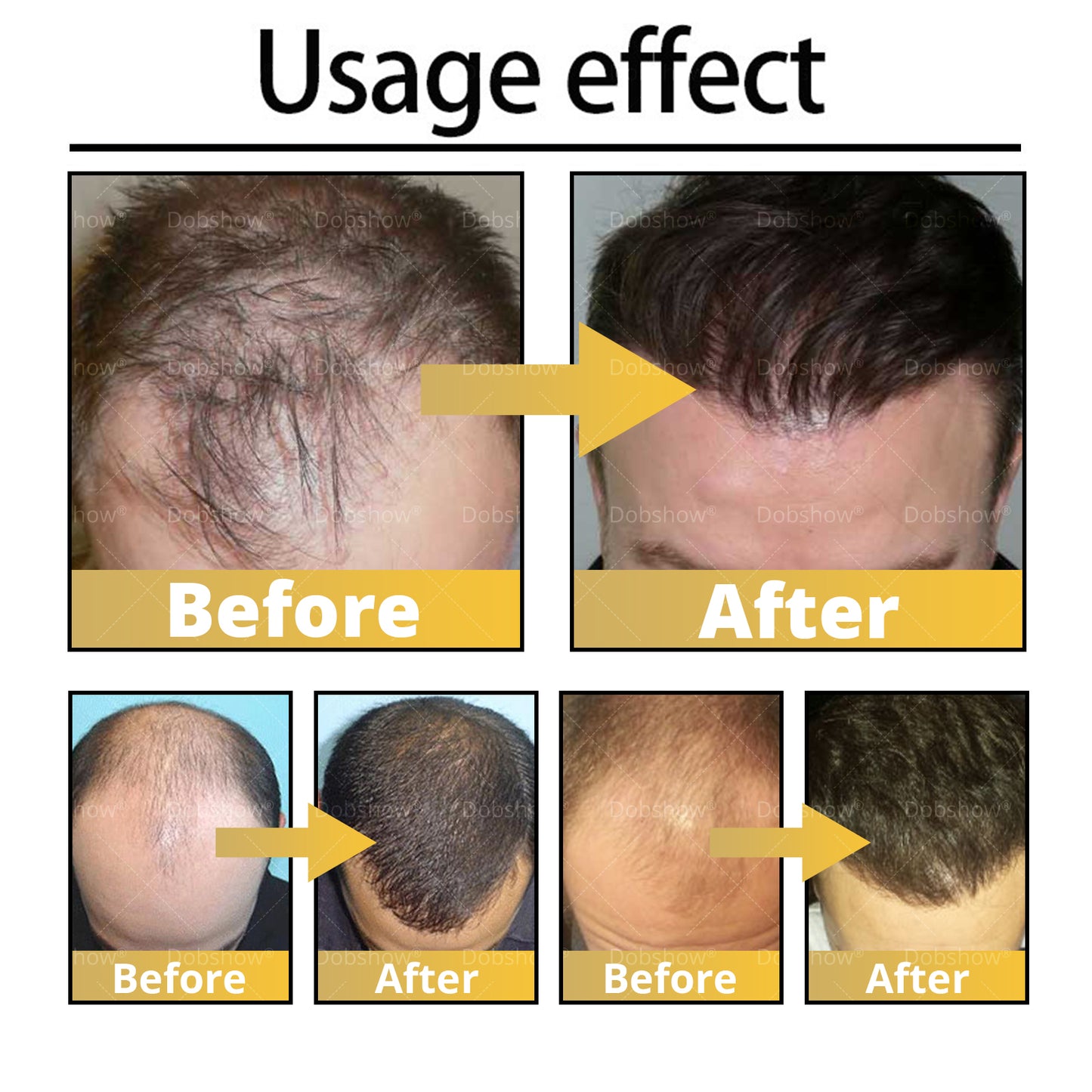 ⓒⓥⓡⓔⓞⓩ® 5% Minoxidil Hair Pro-growth Treatment