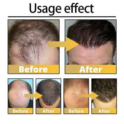 ⓒⓥⓡⓔⓞⓩ® 5% Minoxidil Hair Pro-growth Treatment